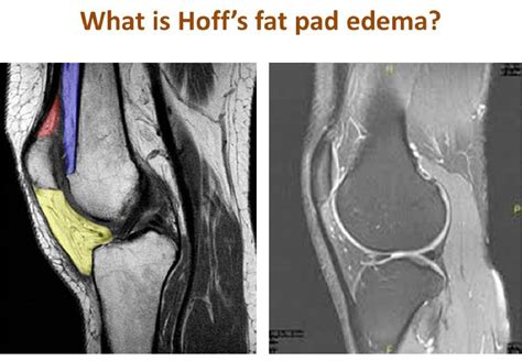 What is Edema in Hoffa's Fat Pad: A Mysterious Dance of Fluid and Tissue